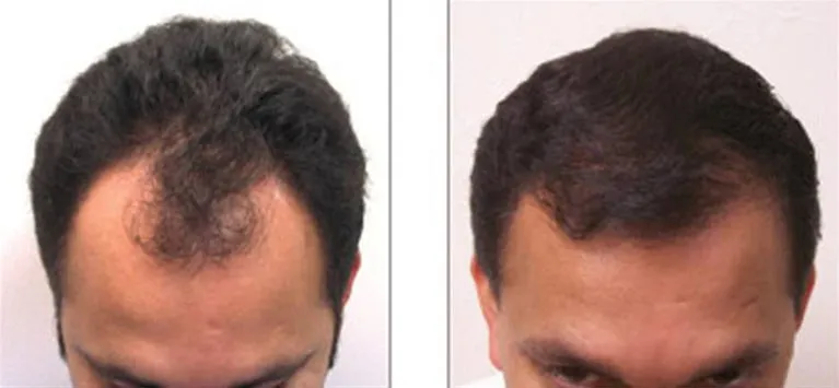 Before and After Neograft