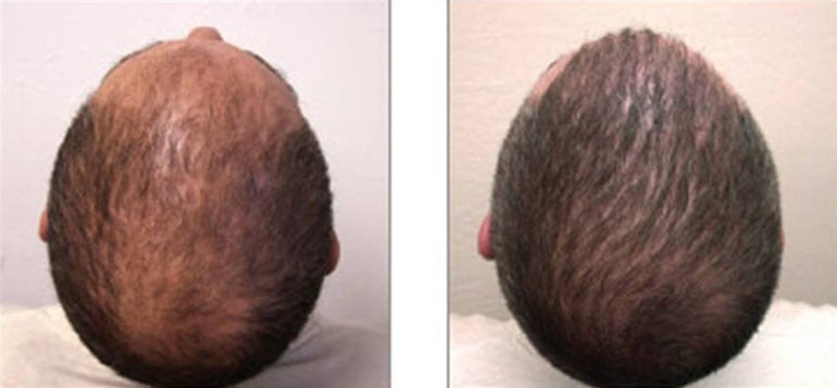 Beforeand After Neograft