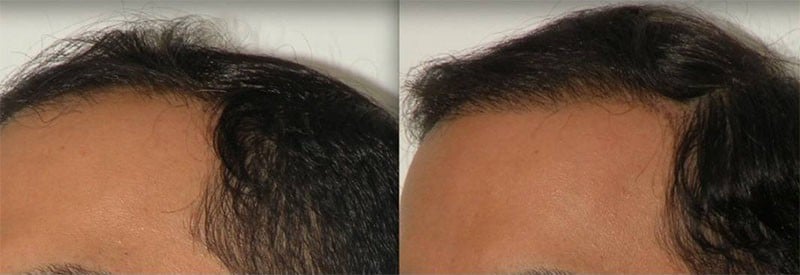 Before and after Neograft